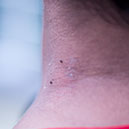 Home Remedies for Warts