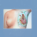 Don’t let the breast cancer to ruin your life